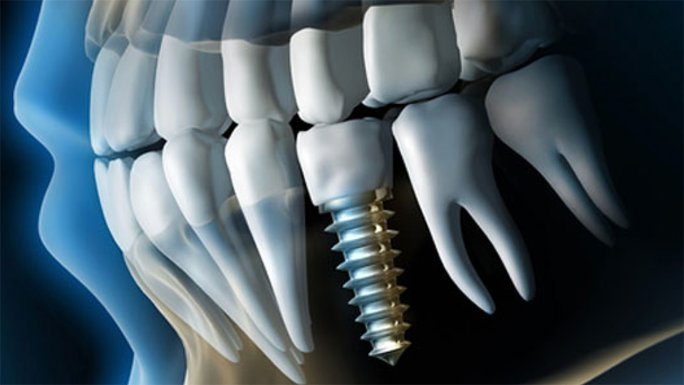 Implant